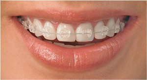 华阳口腔牙齿矫正器种类有哪些？